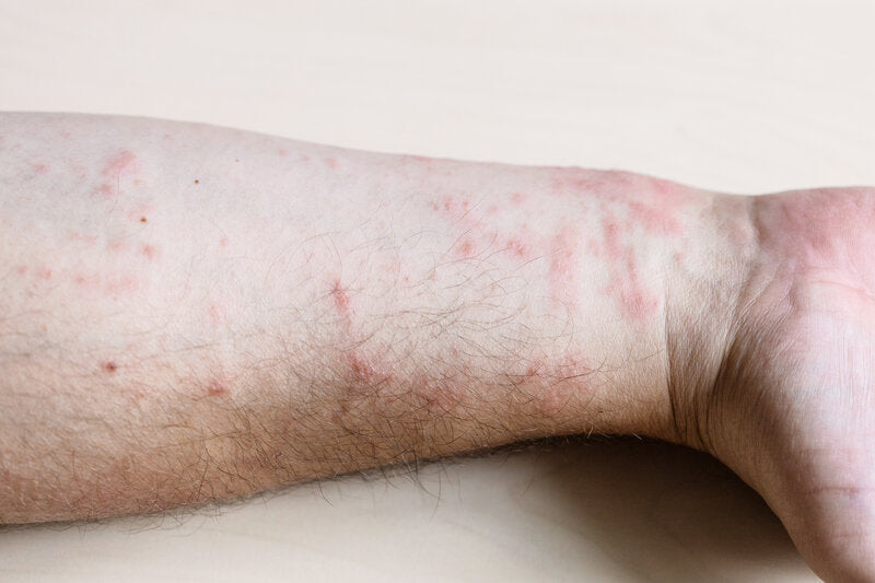 chronic inflammation