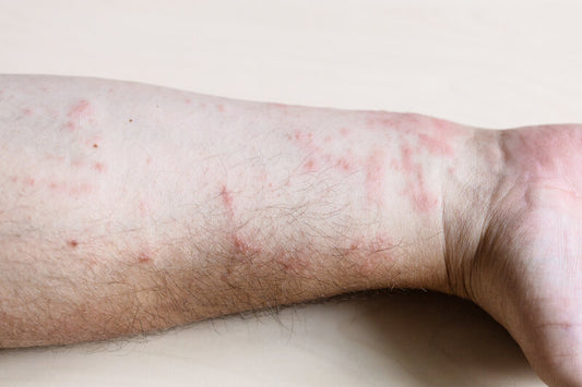 chronic inflammation